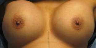 Breast Reconstruction and Breast Deformity Correction Before & After Patient #7981