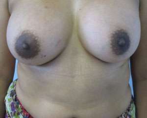 Breast Reconstruction and Breast Deformity Correction Before & After Patient #7987