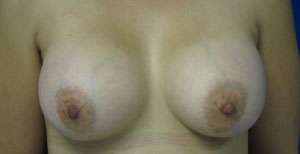 Breast Reconstruction and Breast Deformity Correction Before & After Patient #7990