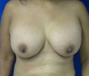Breast Reconstruction and Breast Deformity Correction Before & After Patient #7996