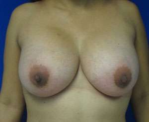 Breast Reconstruction and Breast Deformity Correction Before & After Patient #7999