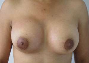 Breast Reconstruction and Breast Deformity Correction Before & After Patient #8005