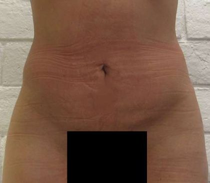 Bodytite Before & After Patient #6086