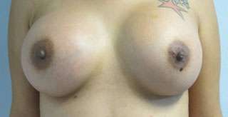 Breast Reconstruction and Breast Deformity Correction Before & After Patient #8020