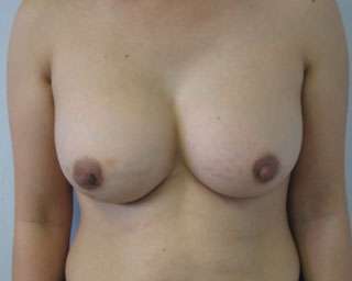 Breast Reconstruction and Breast Deformity Correction Before & After Patient #8023