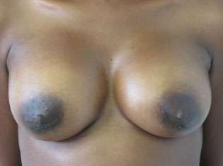 Breast Reconstruction and Breast Deformity Correction Before & After Patient #8035