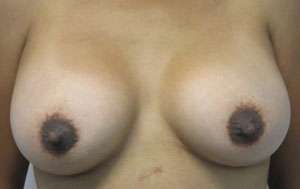 Breast Reconstruction and Breast Deformity Correction Before & After Patient #8041