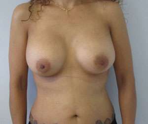 Breast Reconstruction and Breast Deformity Correction Before & After Patient #8044