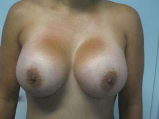 Breast Reconstruction and Breast Deformity Correction Before & After Patient #8056