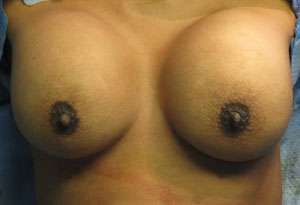 Breast Reconstruction and Breast Deformity Correction Before & After Patient #8059
