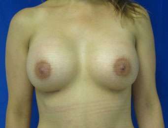 Breast Reconstruction and Breast Deformity Correction Before & After Patient #8065
