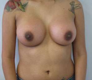 Breast Reconstruction and Breast Deformity Correction Before & After Patient #8074