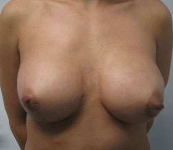 Breast Reconstruction and Breast Deformity Correction Before & After Patient #8083
