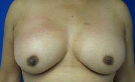 Breast Reconstruction and Breast Deformity Correction Before & After Patient #8098