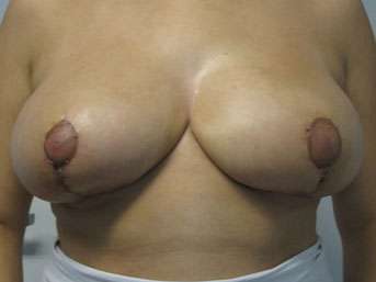 Breast Reduction Before & After Patient #8101