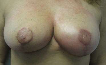 Breast Reduction Before & After Patient #8104