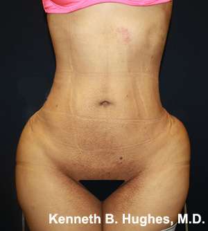 Butt Implants Before & After Patient #8134
