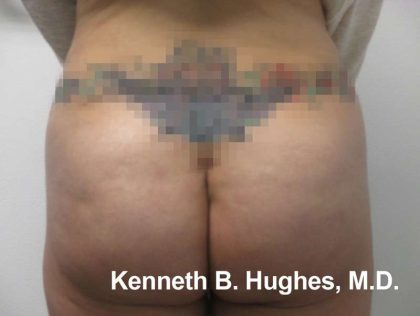 Butt Implants Before & After Patient #8147