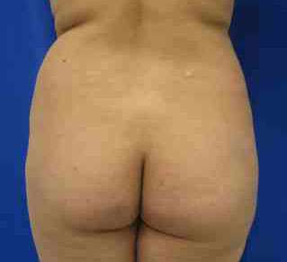 Butt Implants Before & After Patient #8150