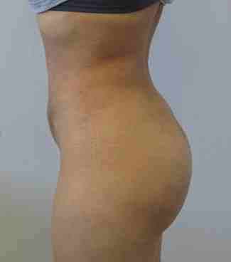 Butt Implants Before & After Patient #8153