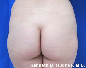 Butt Implants Before & After Patient #8156