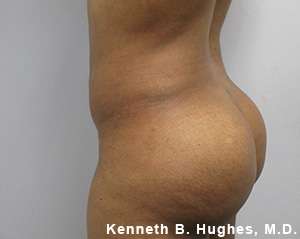 Butt Implants Before & After Patient #8159