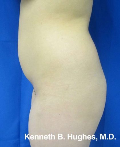 Butt Implants Before & After Patient #8162