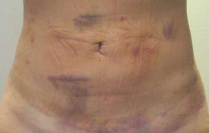 Bodytite Before & After Patient #6103