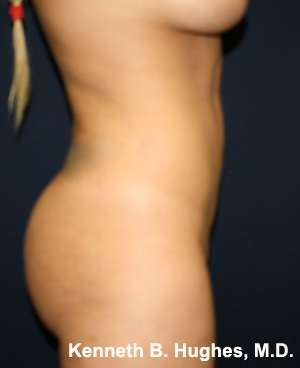 Butt Implants Before & After Patient #8176