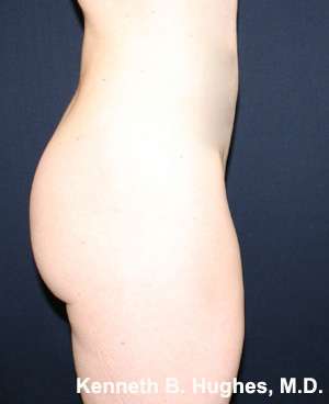 Butt Implants Before & After Patient #8179