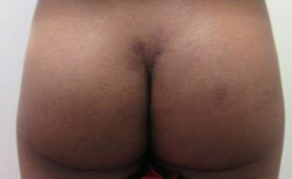 Butt Implants Before & After Patient #8186