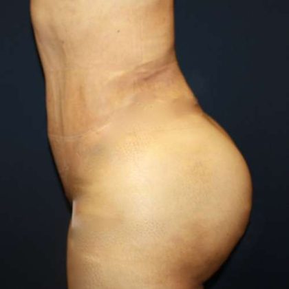 Butt Implants Before & After Patient #8201