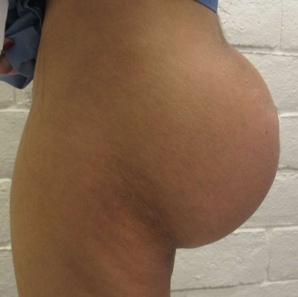 Butt Implants Before & After Patient #8204