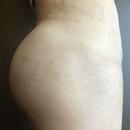Butt Implants Before & After Patient #8207
