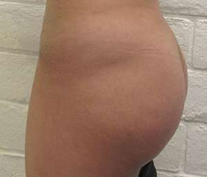 Butt Implants Before & After Patient #8224