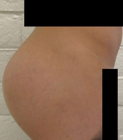 Butt Implants Before & After Patient #8227
