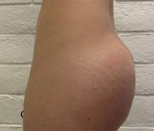 Butt Implants Before & After Patient #8230