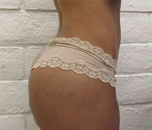 Butt Implants Before & After Patient #8233