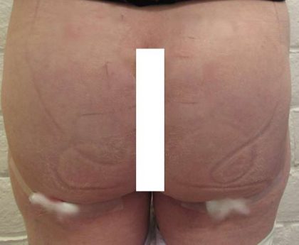 Butt Implants Before & After Patient #8236