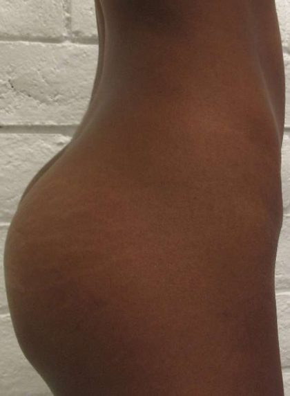 Butt Implants Before & After Patient #8241