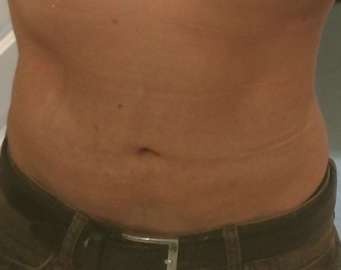 Bodytite Before & After Patient #6111