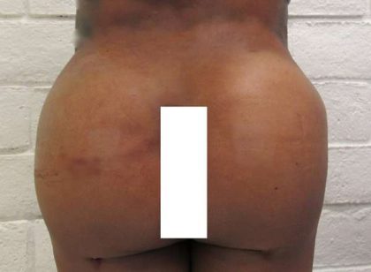 Butt Implants Before & After Patient #8253