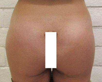 Butt Implants Before & After Patient #8256