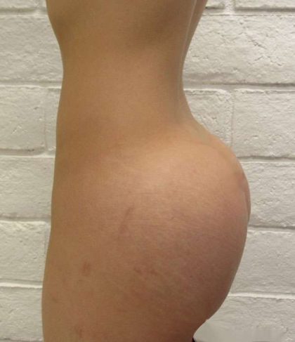 Butt Implants Before & After Patient #8262