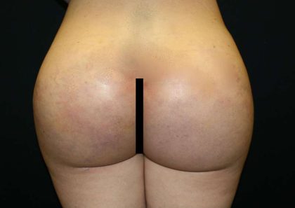 Butt Implants Before & After Patient #8268