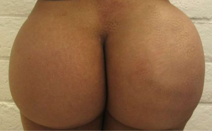 Butt Implants Before & After Patient #8274