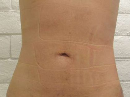 Bodytite Before & After Patient #6114