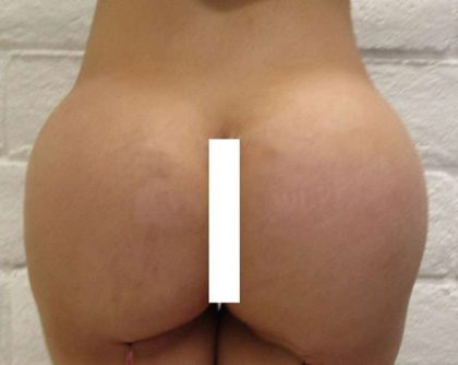 Butt Implants Before & After Patient #8285