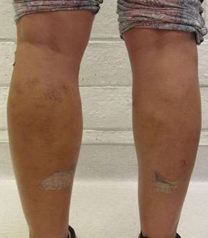 Calf Liposuction Before & After Patient #8288