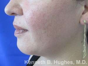 Chin Implant Before & After Patient #8291